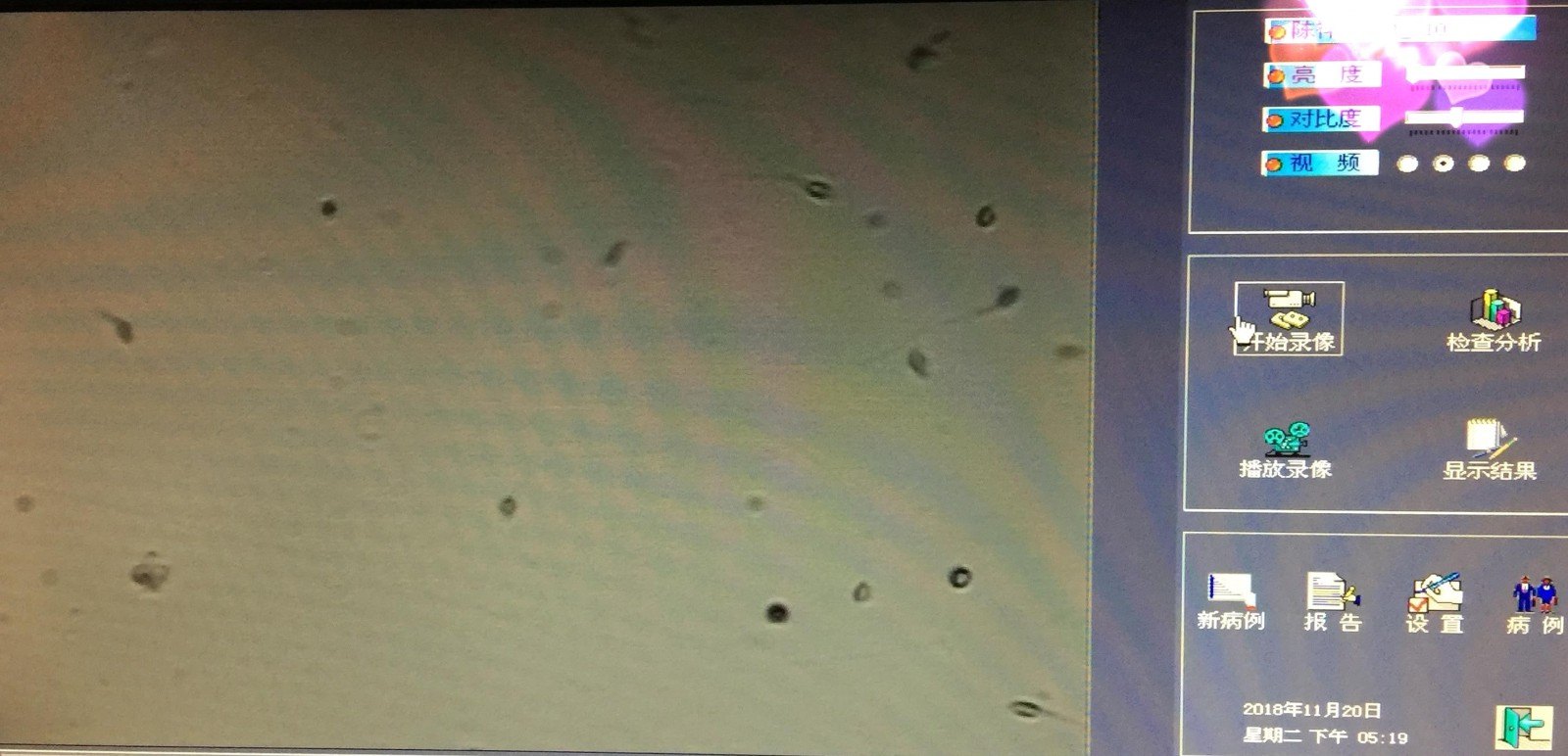 小陈术后检测到精子的图像.jpg