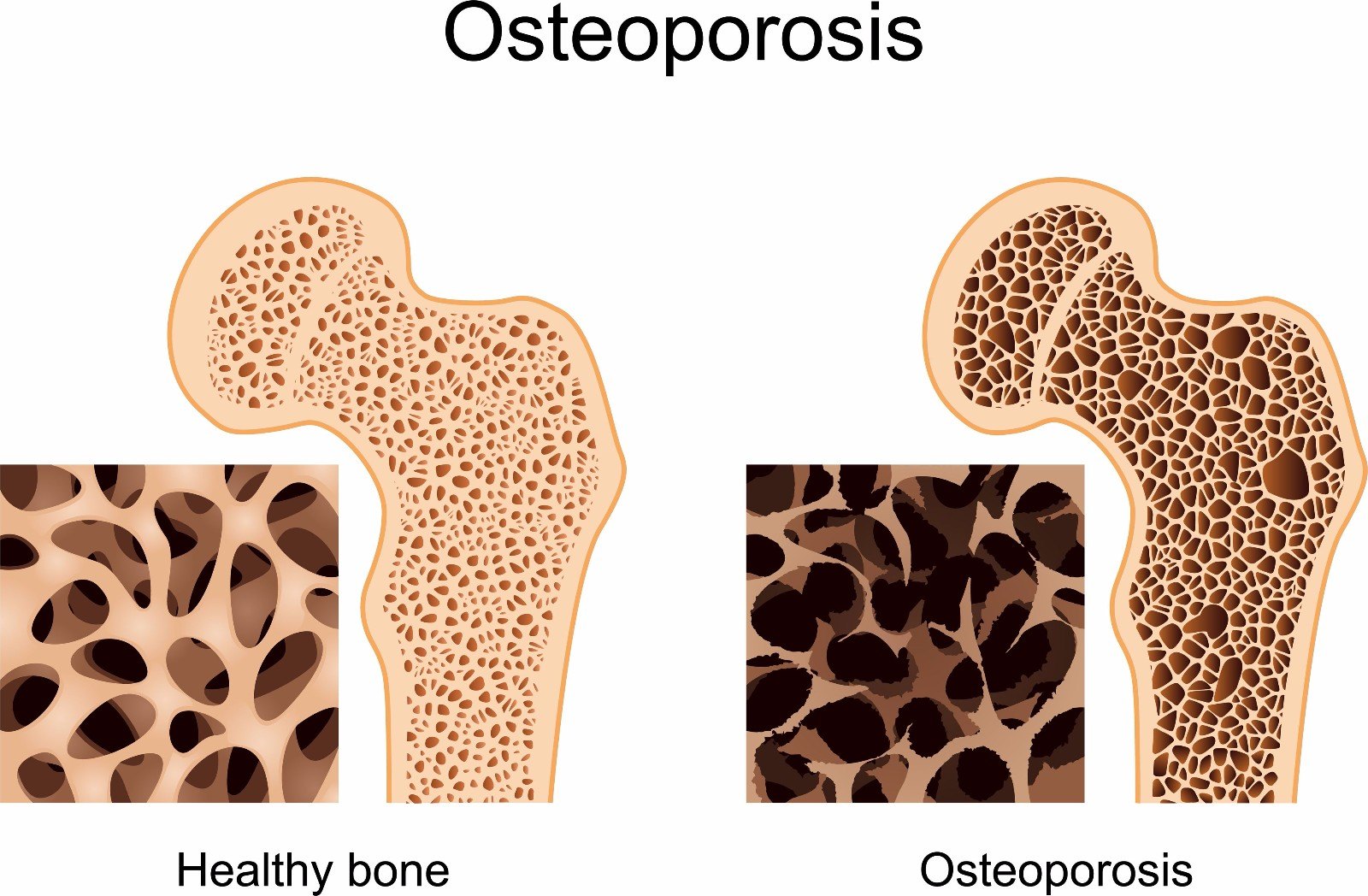 osterporosis.jpg