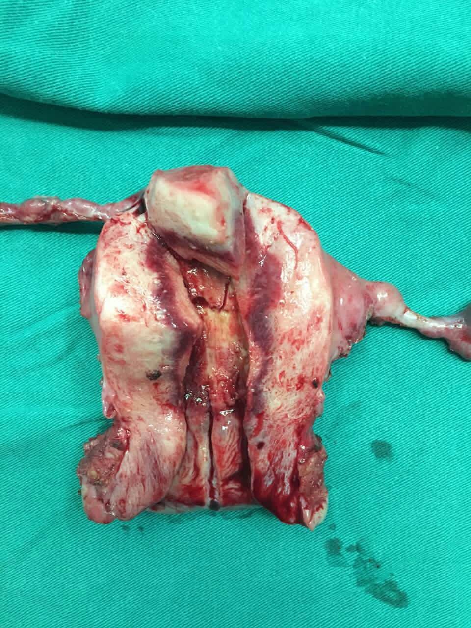 宫颈部分切除术图片图片