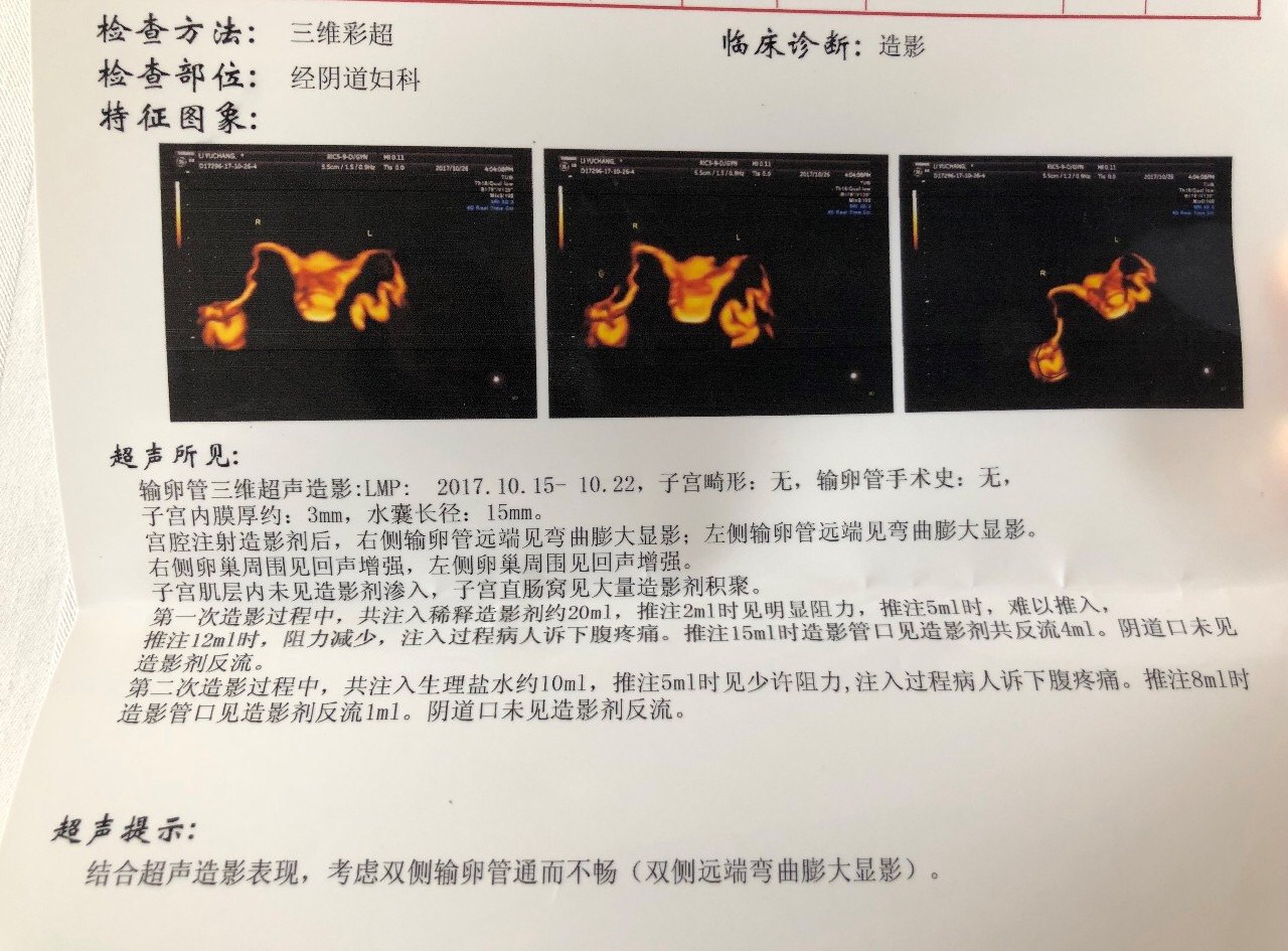 輸卵管積水用哪些方法可以診斷原創