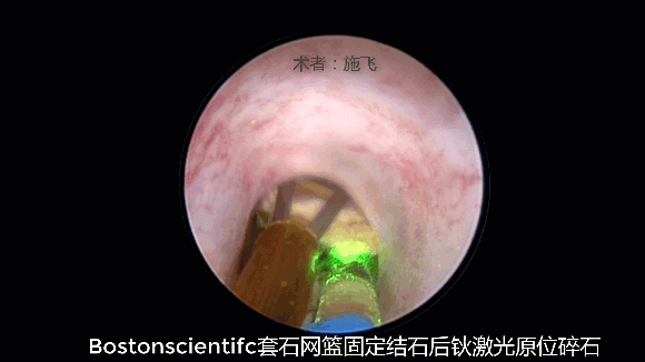 套石篮钬激光施飞.gif