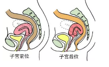 子宫后位会影响怀孕么?