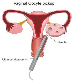 oocyte-pickup.jpg