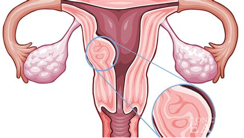 yue qiu fibroma 1.png