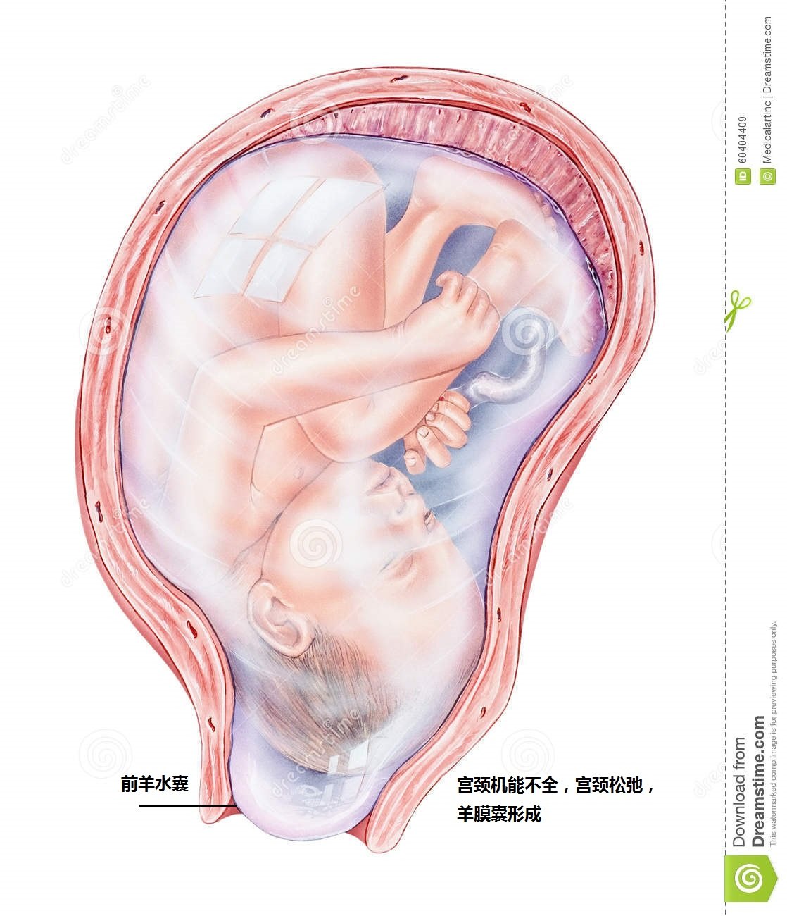 pregnancy-immature-premature-labor-shown-fetus-placenta-top-uterus-umbilical-cord-uterus-bulging-60404409.jpg