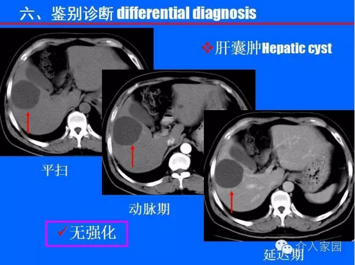 肝臟海綿狀血管瘤-基礎與介入 (轉載)