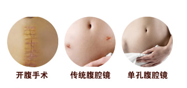 单孔腹腔镜.png