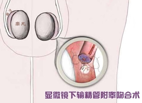 显微镜下输精管附睾吻合术手术记录图.jpg