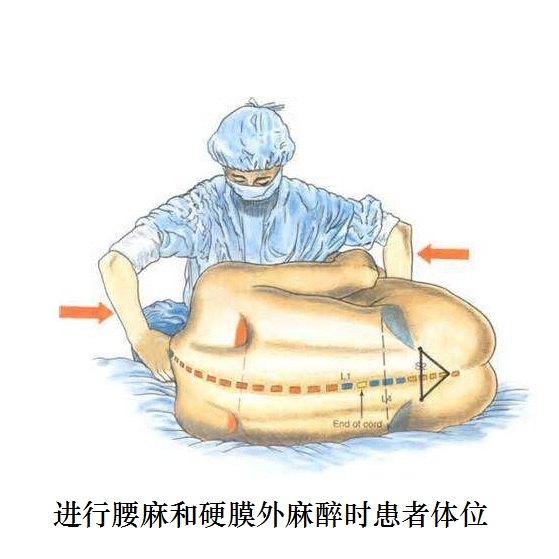 腰麻.jpg