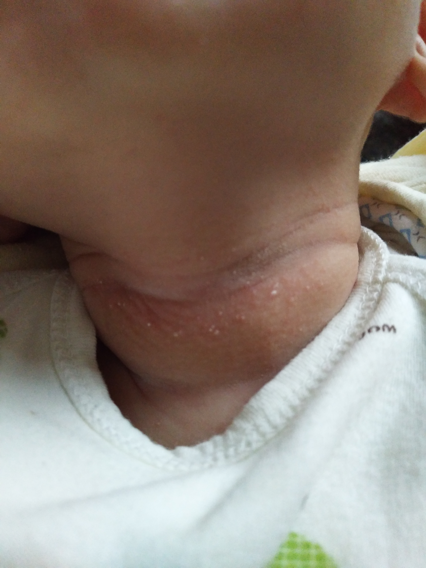 宝宝脖子长脂肪粒图片图片
