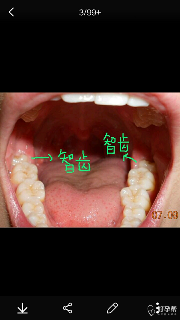 我的智齿长了两个我昨天晚上