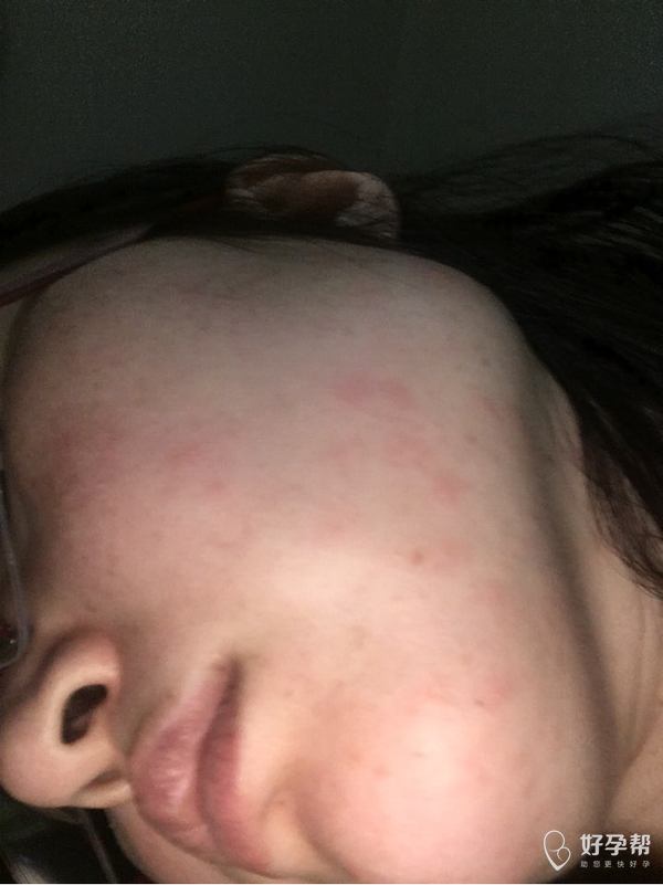 今天下午突然脸上起了很多红疙瘩痒痒的