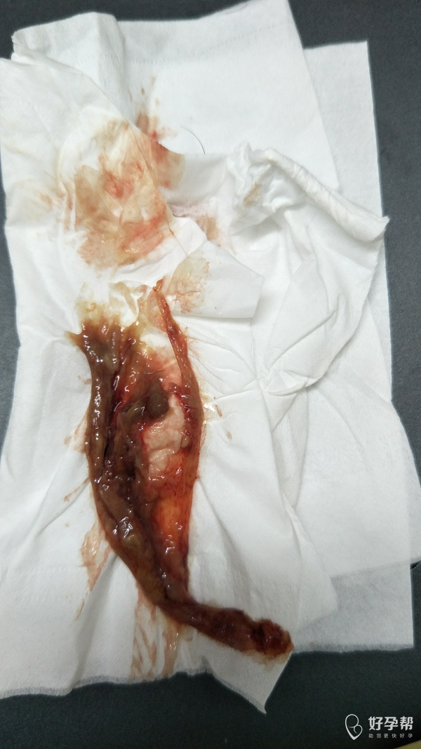 剖腹产两个月有图慎入