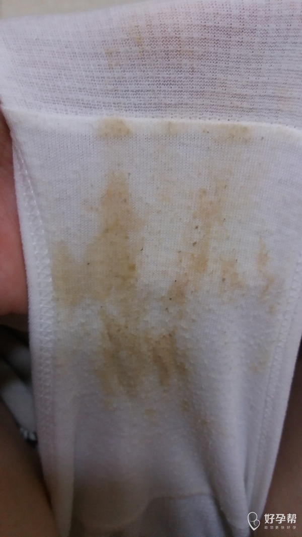 孕15周,有褐色分泌物,怎么办