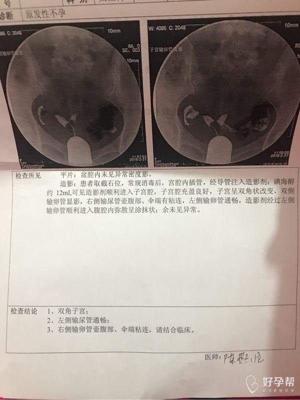 双输卵管是什么意思 gw-topic