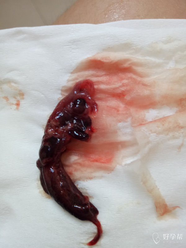 促排阶段,不知道排的什么,麻烦懂的看看