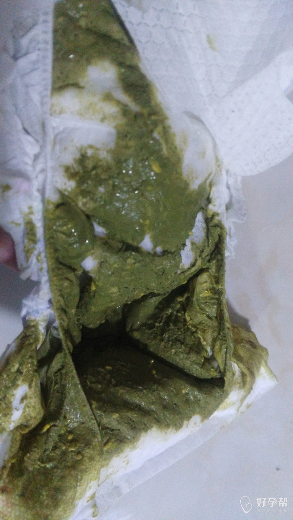 医生你好宝宝最近几天拉的绿色屎不知道是为什么有图帮忙一下