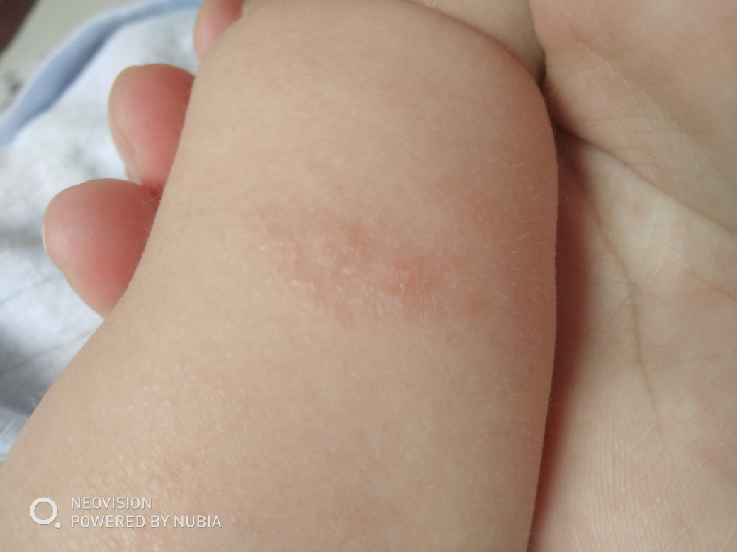 婴幼儿病毒疹图片