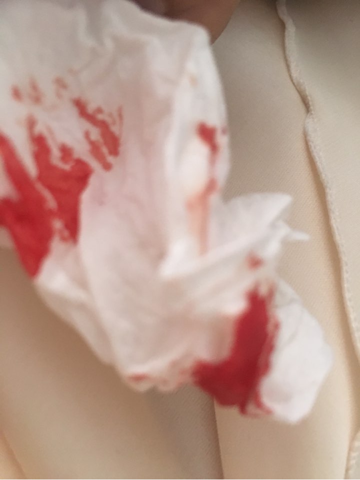 流鼻血照片真实卫生纸图片
