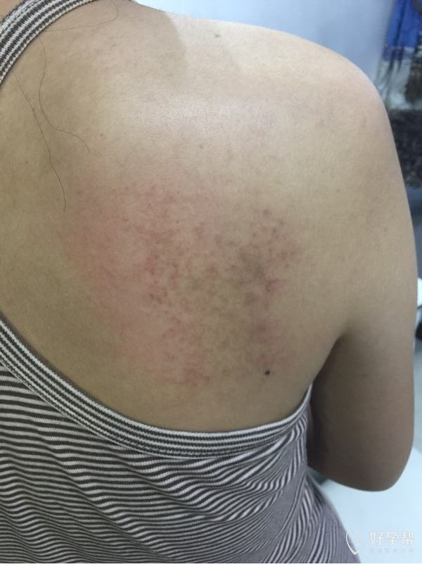 怀孕19周后背痒能抹药吗