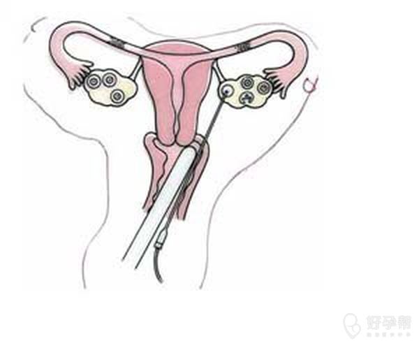 【试管圈话题】取卵后腹水了吗?分享下你是怎么解决的?