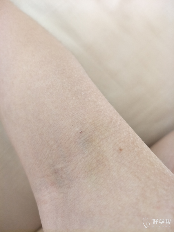 两只手的淤青终于都散了