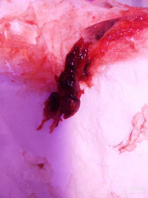 月经推迟半个月今天来了晚上排出来一块肉体