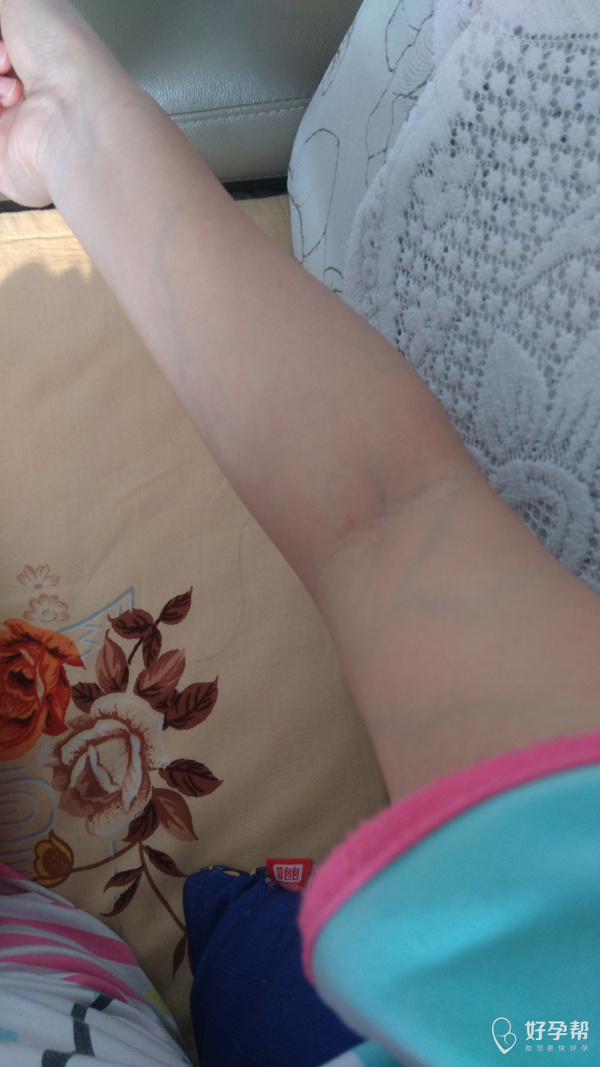 胳膊腿上都是,腿上更清晰,毛细血管都能看清.