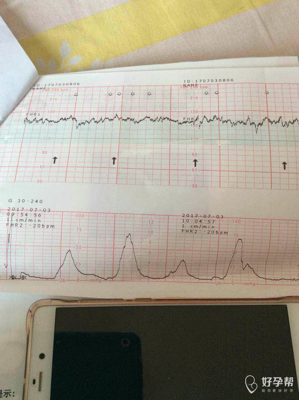 孕35周胎心監護有宮縮