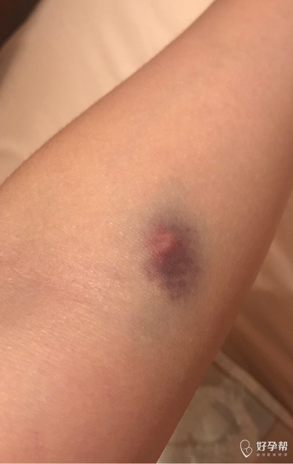 试管婴儿圈-好孕帮