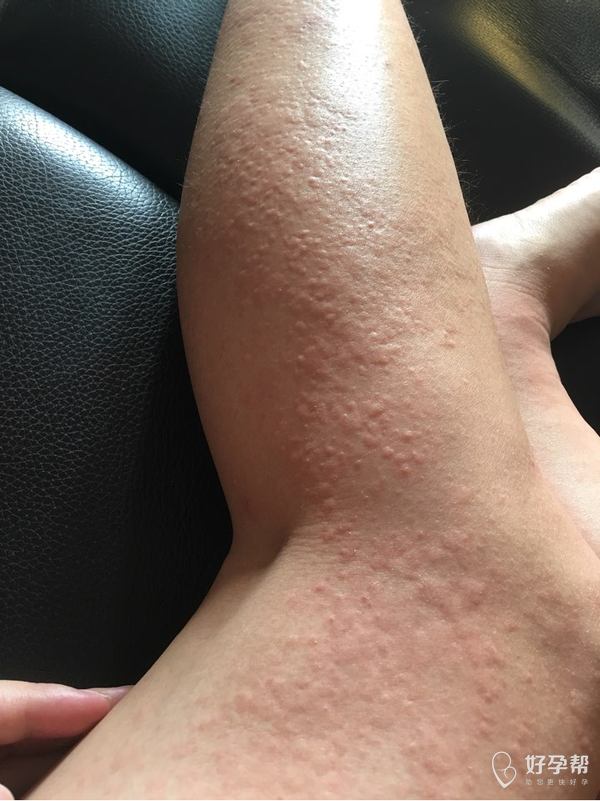 求助医生,腿上长了好多包