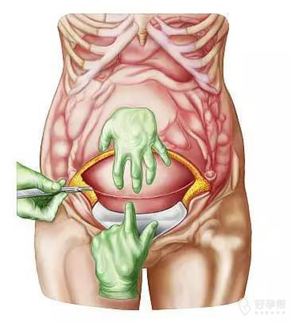 要一个孩子受多大的罪 很痛苦的 说不害怕是假的有谁肚子上一刀又一刀