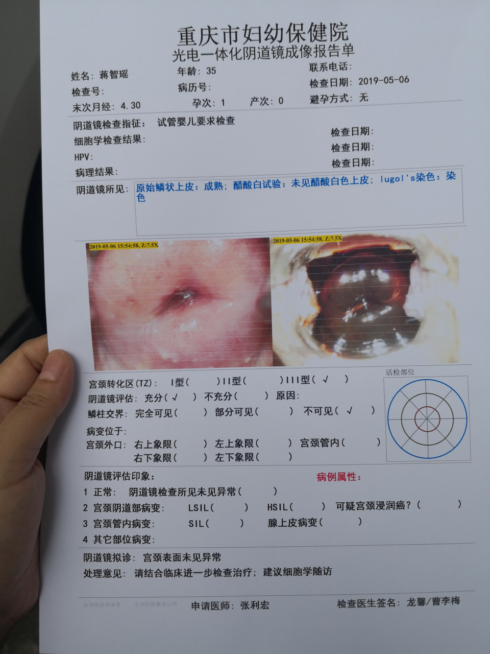 阴道镜转化区iii型鳞柱交界不可见是