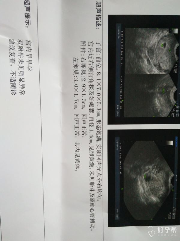 孕65天有少量血怀宫低还有保胎的必要吗