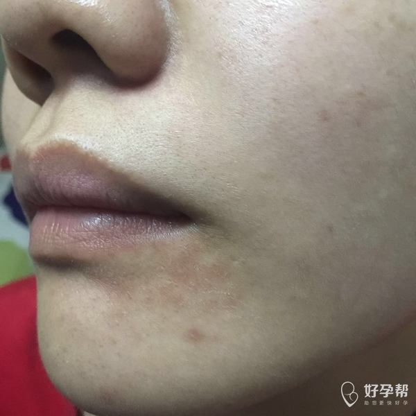 为什么我两边嘴角会这样呢?