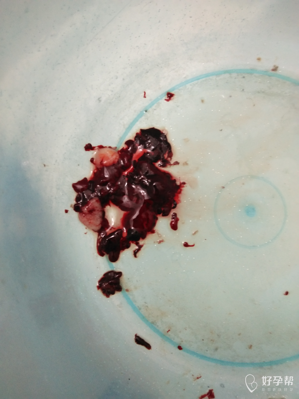 邹平县台子镇卫生院您好,白色的是孕囊,看着孕囊都完整排出了