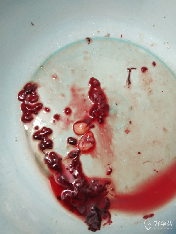 邹平县台子镇卫生院您好,白色的是孕囊,看着孕囊都完整排出了