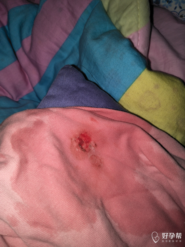 小孩喂奶时吐血,怎么回事?