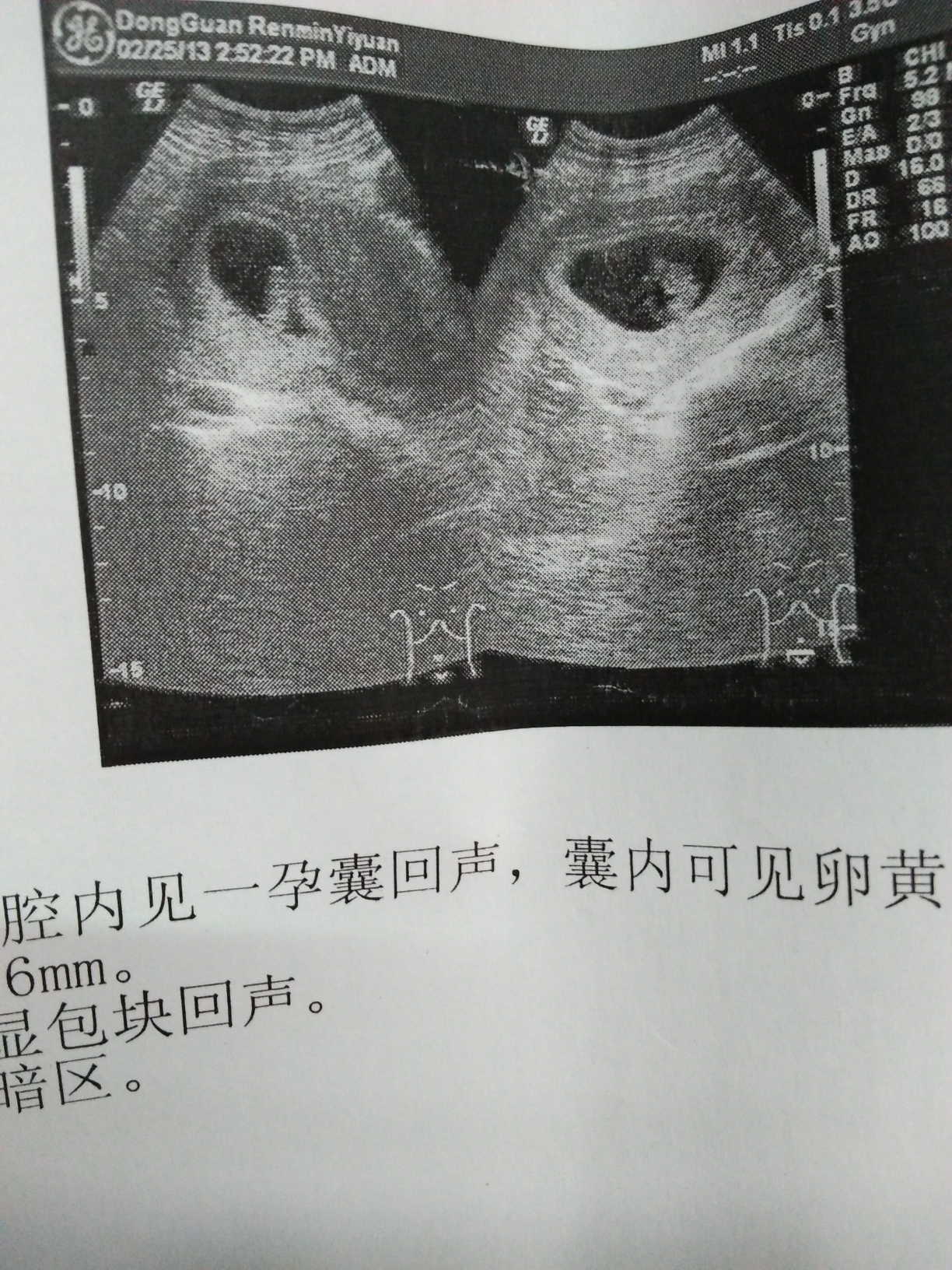 怀孕2周孕囊大小图片图片