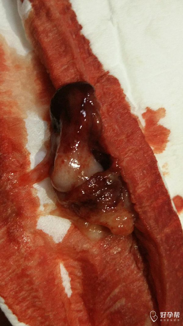 今天月经第一天,排出这样的东西,有人知道吗?