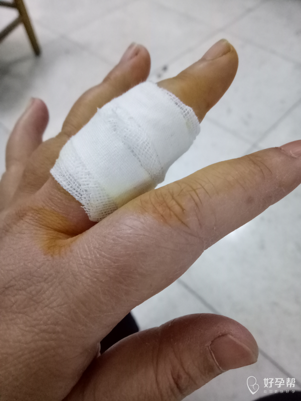 之前发的手破的帖子收到很多姐妹的关心!谢谢了,已经缝针了,但愿快点