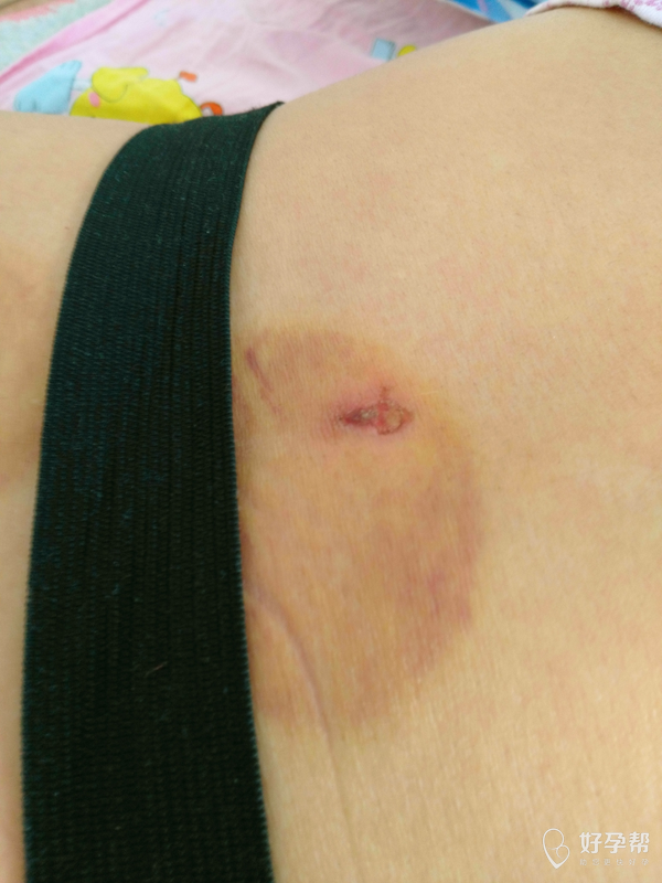 后背痒痒挠了,结果破皮了