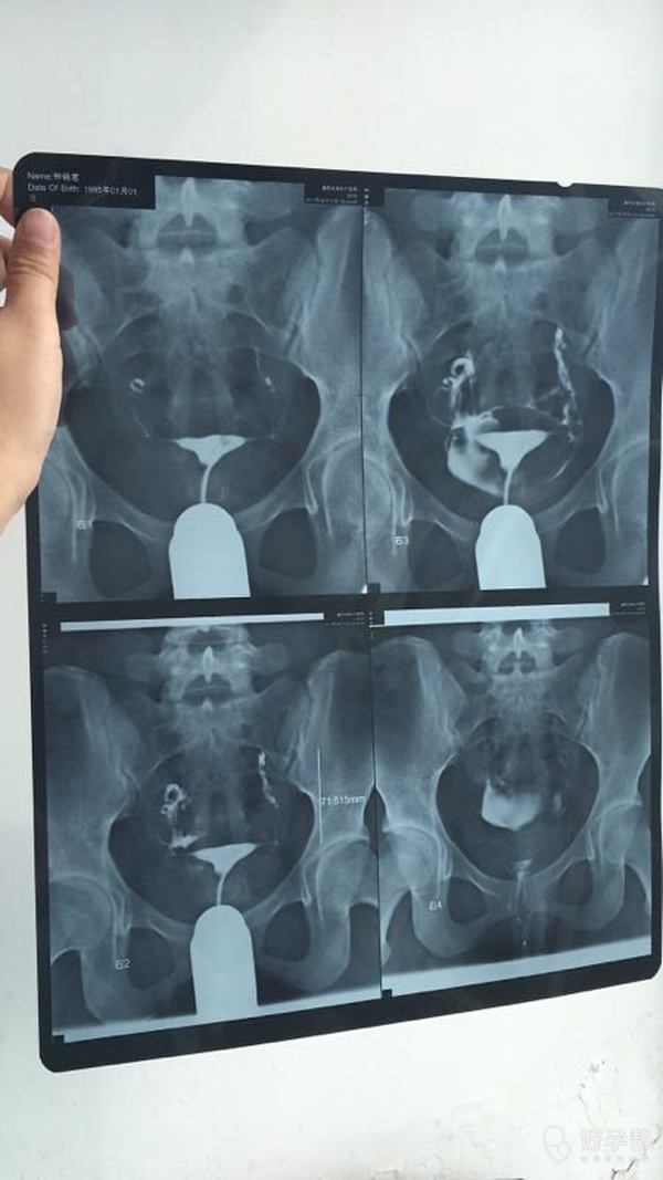 输卵管照影结果,请问怎么解读