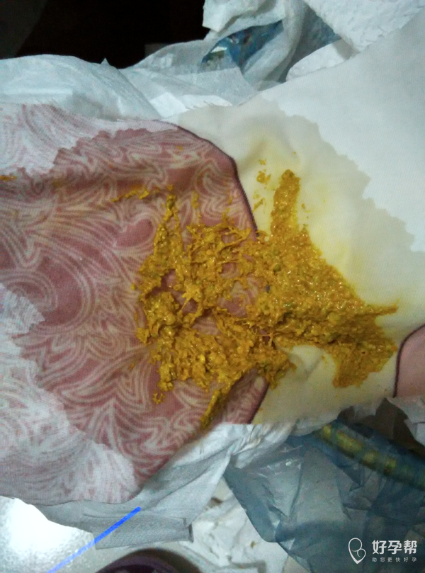 请问医生宝宝拉黄色的奶瓣和吐奶该怎么办?有图慎入,别嫌恶心!