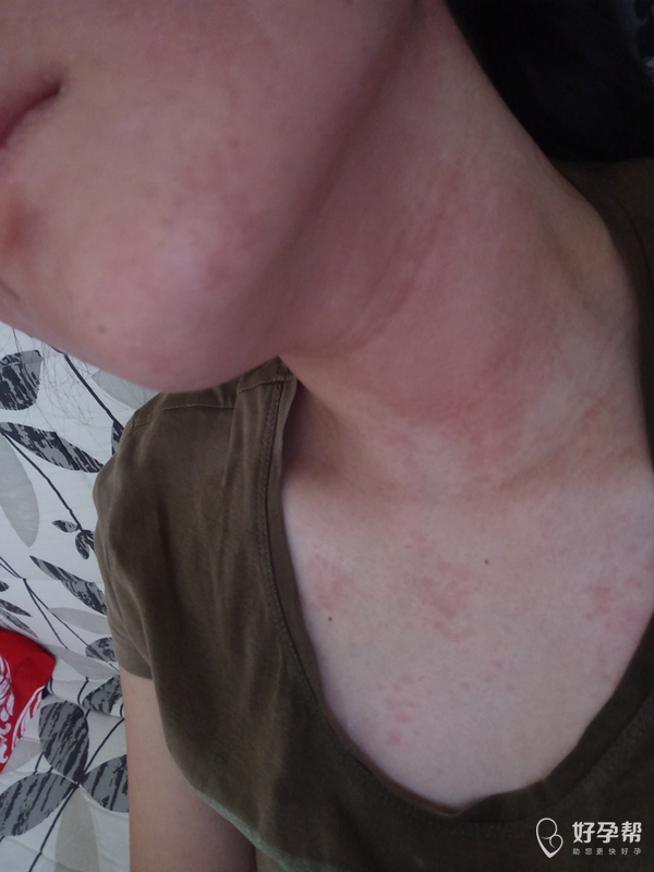 孕三个月,皮肤过敏一周了,开始以为是吃芒果吃的,又像太阳晒过敏的,用