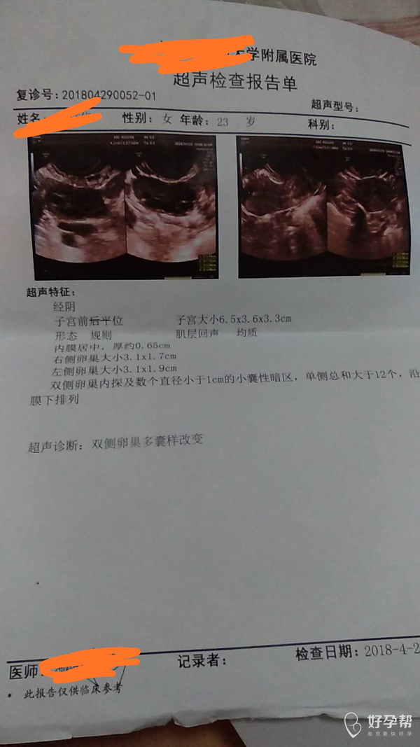 什么叫做多囊卵泡 gw-topic