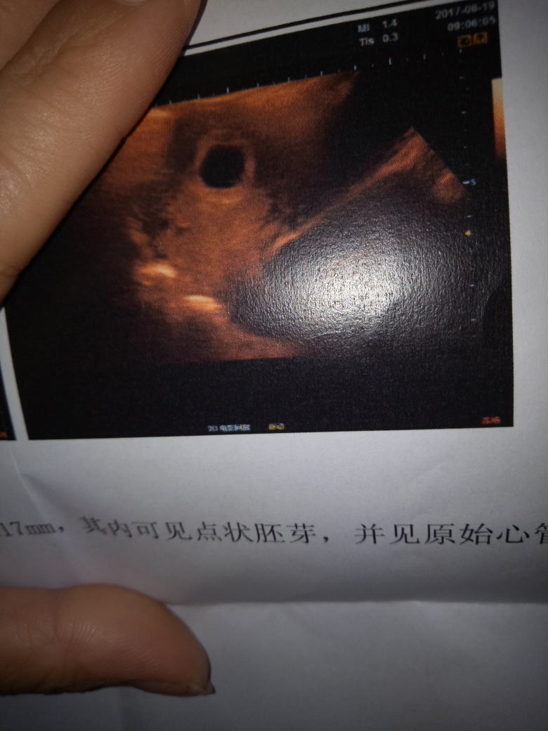 女孩的孕囊形状图片图片