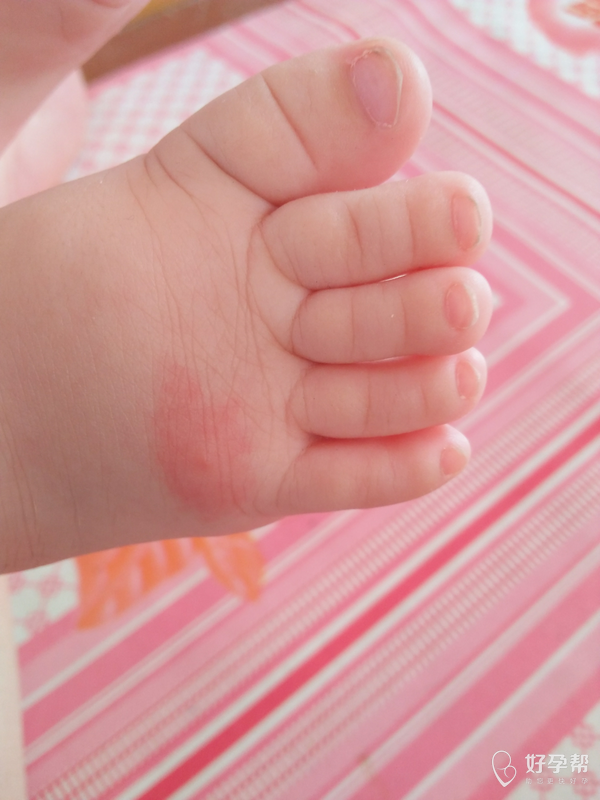 大家帮忙看看我家宝宝脸上让蚊子咬的这样抹什么好的快