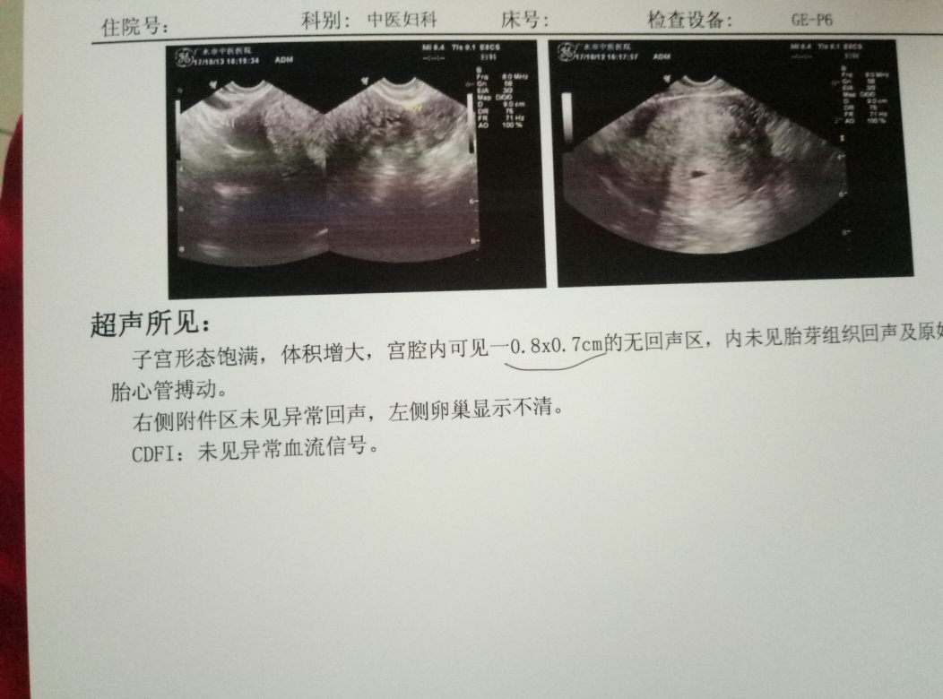 求助,怀孕39天,因为孕酮偏低,医生让做阴超排除宫外孕.