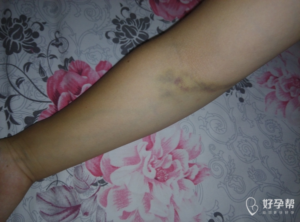 还是宝宝出生那天抽血抽的,青了好大一块,还有点酸酸的痛!